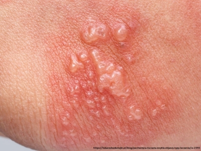 Zwiększony stres oksydacyjny w pęcherzycy zwykłej związany z aktywnością HLA