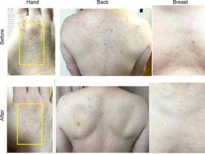 Wpływ kąpieli wodnej bogatej w wodór na tłuszcz trzewny i plamy skórne,