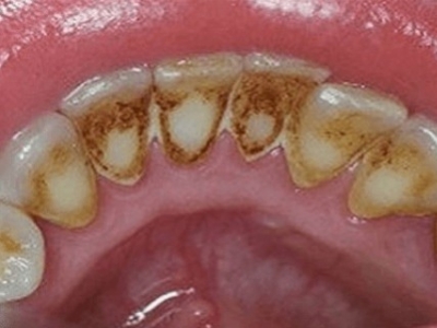 Ocena działania przeciwbakteryjnego wody wodorowej na płytkę nazębną u pacjentów