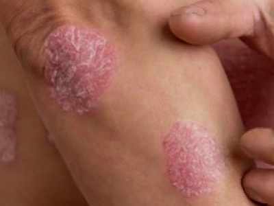 Poprawa zapalenia stawów związanego z łuszczycą i zmian skórnych....