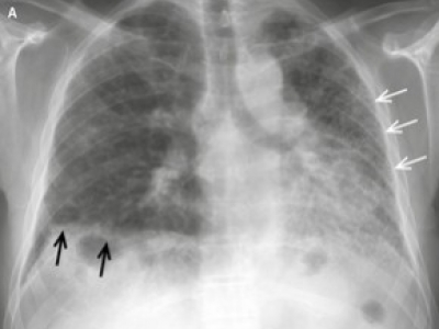 Zrozumienie toksyczności tlenu.