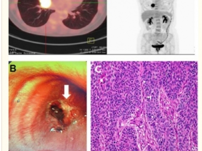 Retrospektywne  badanie leczenia raka  wodorem molekularnym