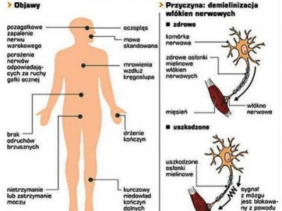 Rola stresu oksydacyjnego w patogenezie stwardnienia rozsianego.
