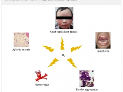 Wodór molekularny w walce z chłoniakiem.