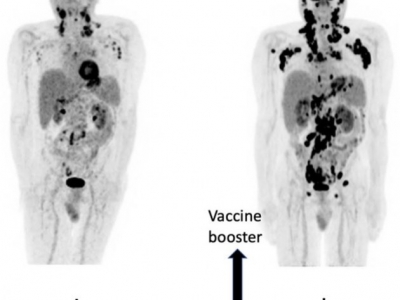 Szybka progresja chłoniaka angioimmunoblastycznego z komórek T 