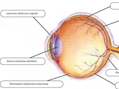 Potencjalne zastosowania wodoru w  strategii terapeutycznej w chorób oczu